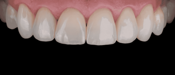 Kokiais atvejais estetinis plombavimas yra nerekomenduojamas?