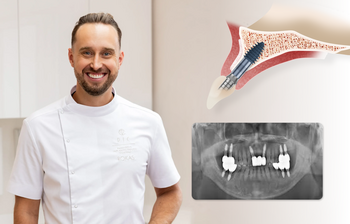 Kaulo trūkumas nebėra nuosprendis: kada dantų implantacija galima be sudėtingų priauginimo procedūrų?