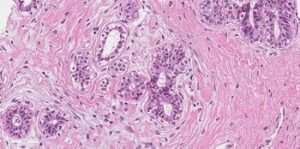Kol pacientė laukia biopsijos atsakymo: ką apie krūties vėžį atskleidžia patologijos tyrimai? (Atnaujinta)
