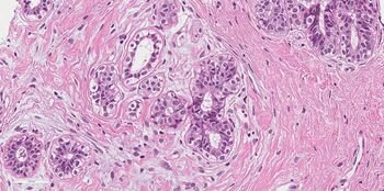 Kol pacientė laukia biopsijos atsakymo: ką apie krūties vėžį atskleidžia patologijos tyrimai? (Atnaujinta)
